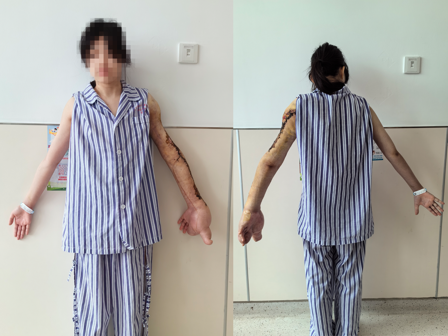 術后正背面組合_副本.png